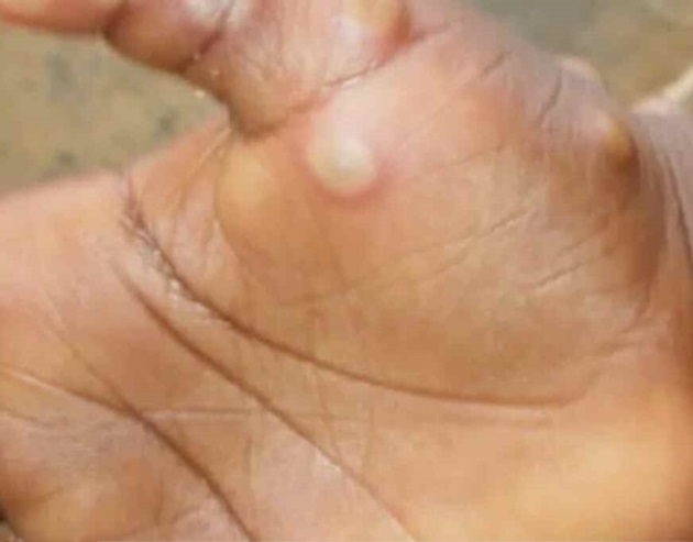 Suspected  case of "Monkeypox" in India under probe: GOI